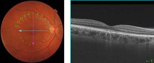 OCT- optyczna koherentna tomografia
